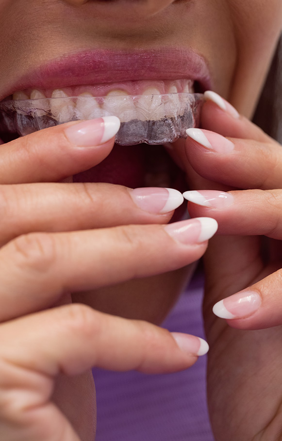 Clear teeth aligners Bankstown - Clear aligners near me