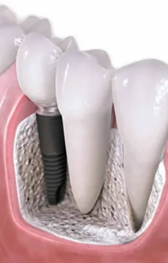 Dental Inplant Smile Line Dental - Dental Inplant Bankstown