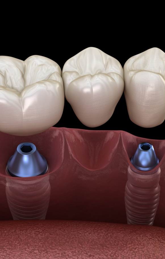 Quality Dental Inplant Bankstown - Dental Inplant Online
